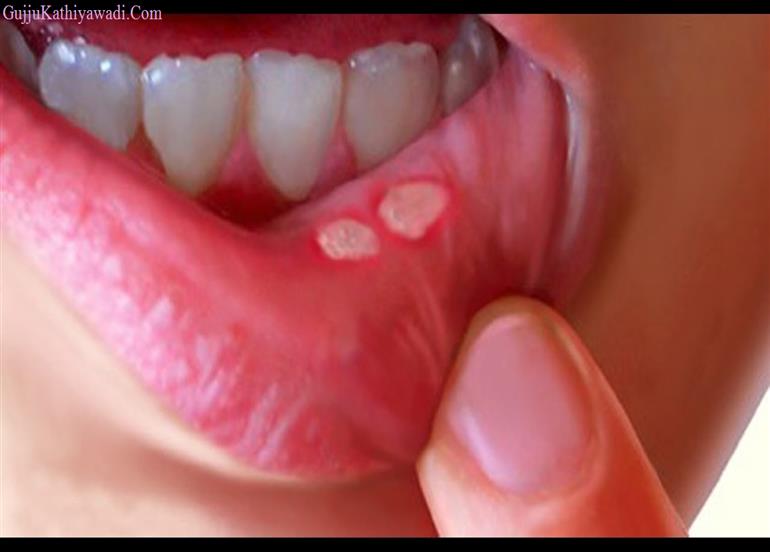 મોંમાં પડતા ચાંદાની સમસ્યાને કાયમ માટે દૂર કરવા કરો આ સહેલા ઉપાય