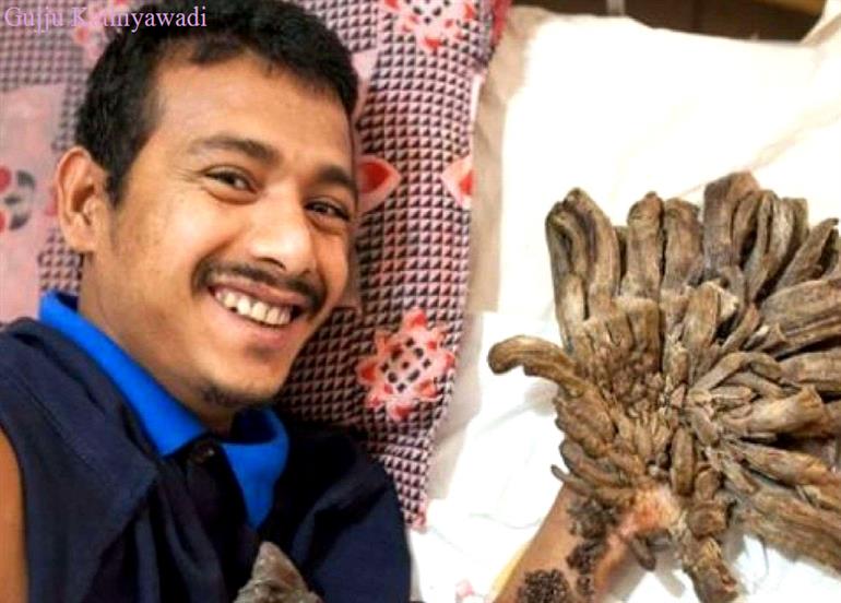 हाथ-पैर में रोज़ उग आते हैं पेड़! दर्द से बचने के लिए कहा- प्लीज मेरे हाथ काट दो