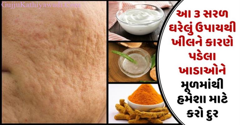 આ ૩ સરળ ઘરેલું ઉપાયથી ખીલને કારણે પડેલા ખાડાઓને મૂળમાંથી હમેશા માટે કરો દુર